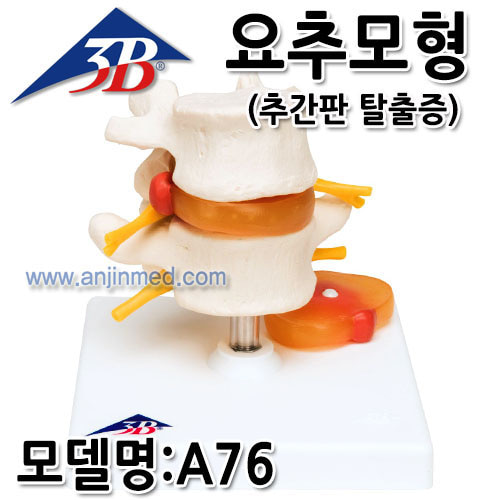 3B 요추모형 (추간판탈출증) (모델:A76) [EU생산] (a2157)