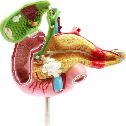 담낭 췌장 십이지장 병리적 모형