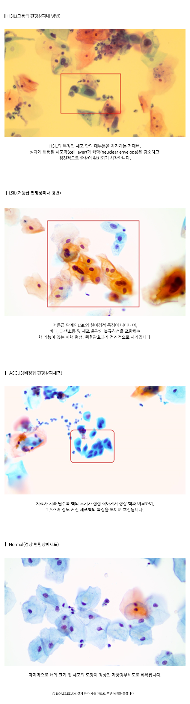 HSIL(고등급 편팡상피내 병변), LSIL(저등급 편평상피내 병변), ASCUS(비정형 편평상피세포), Normal(정상 편평상피세포)